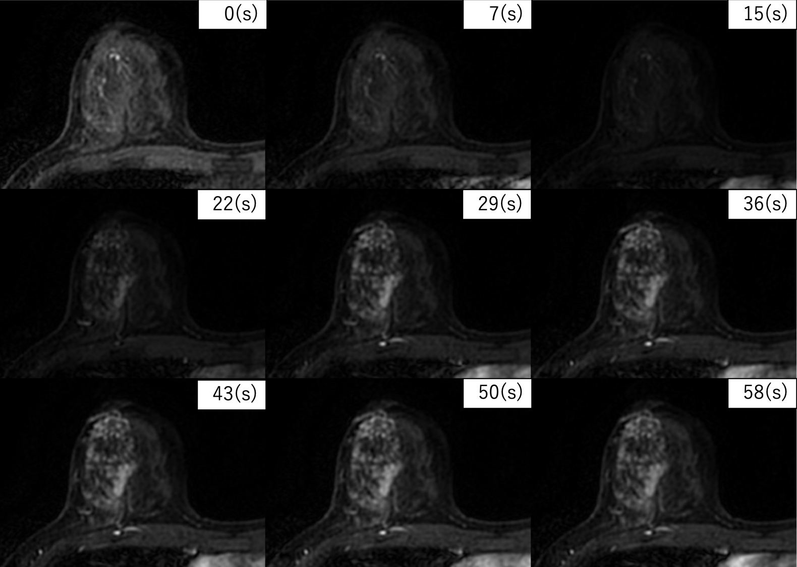 図5．超高速造影ダイナミックMRI画像