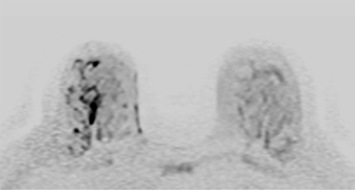 図6．拡散強調画像