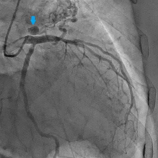 図3．冠動脈造影（左冠動脈）RAO:CAU