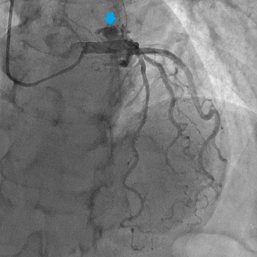 図4．冠動脈造影（左冠動脈）LAO:CRA