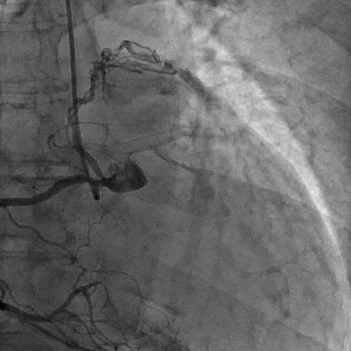 図5．冠動脈造影（右冠動脈）AP拡張期