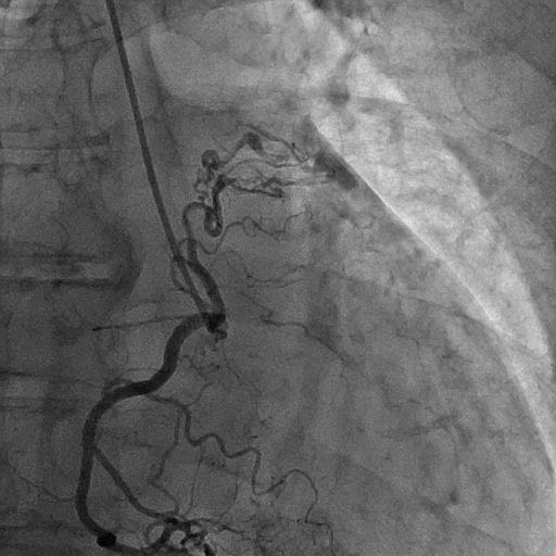 図6．冠動脈造影（右冠動脈）AP収縮期