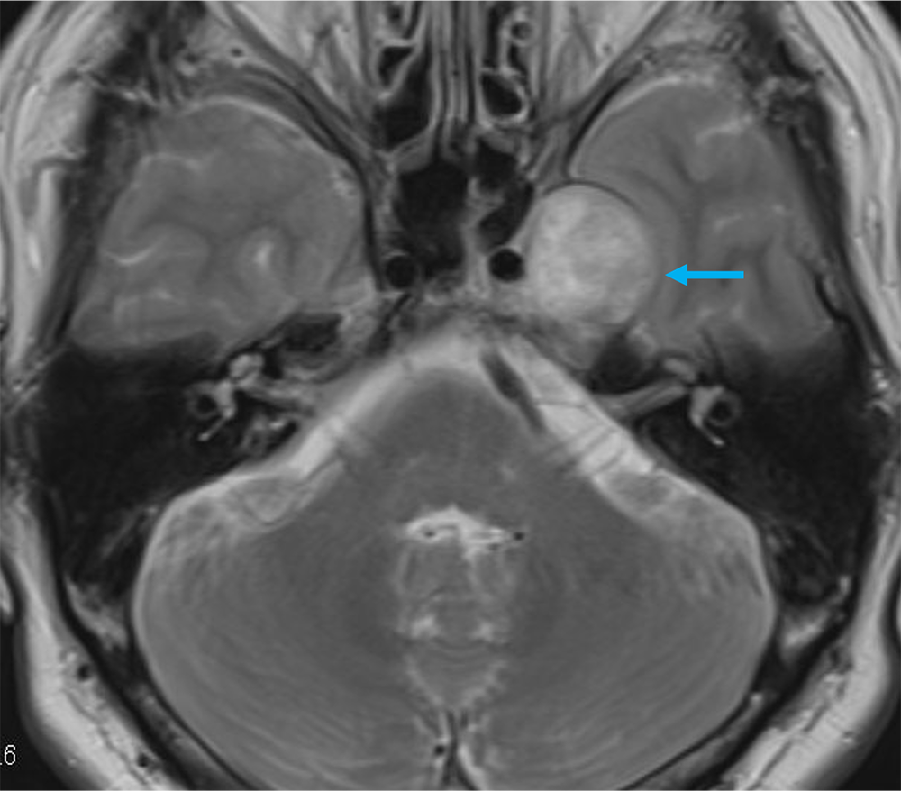 図1．T2強調画像 軸位断