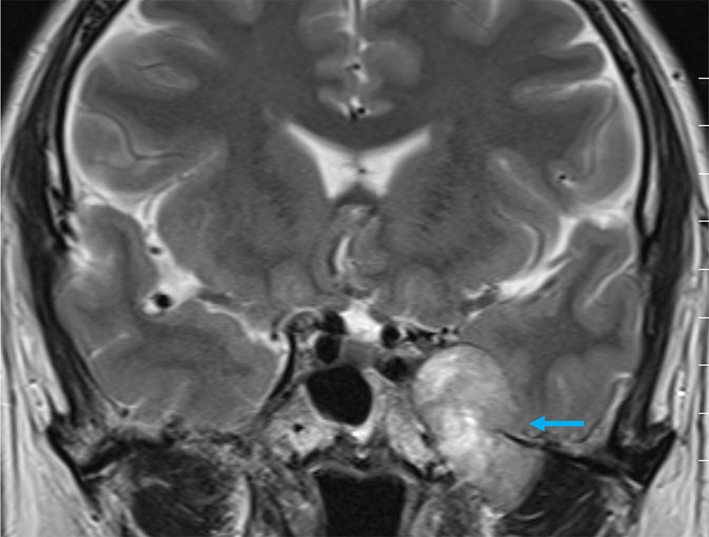 図2．T2強調画像 冠状断