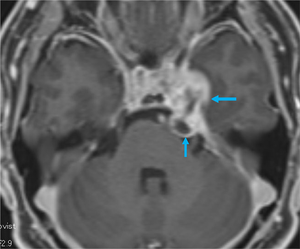 図3．造影MRI 脂肪抑制T1強調画像 軸位断