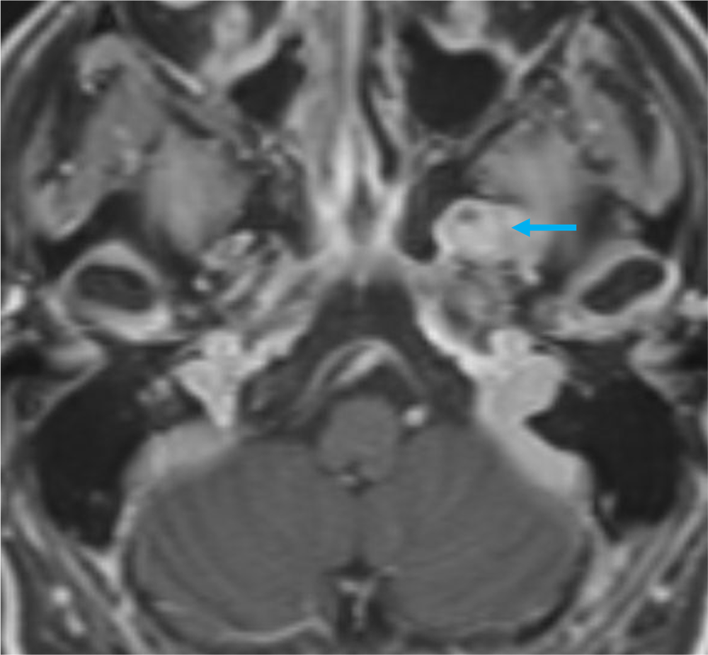 図4. 造影MRI 脂肪抑制T1強調画像 軸位断