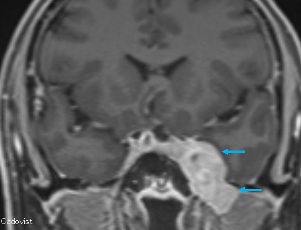 図5．造影MRI 脂肪抑制T1強調画像 冠状断
