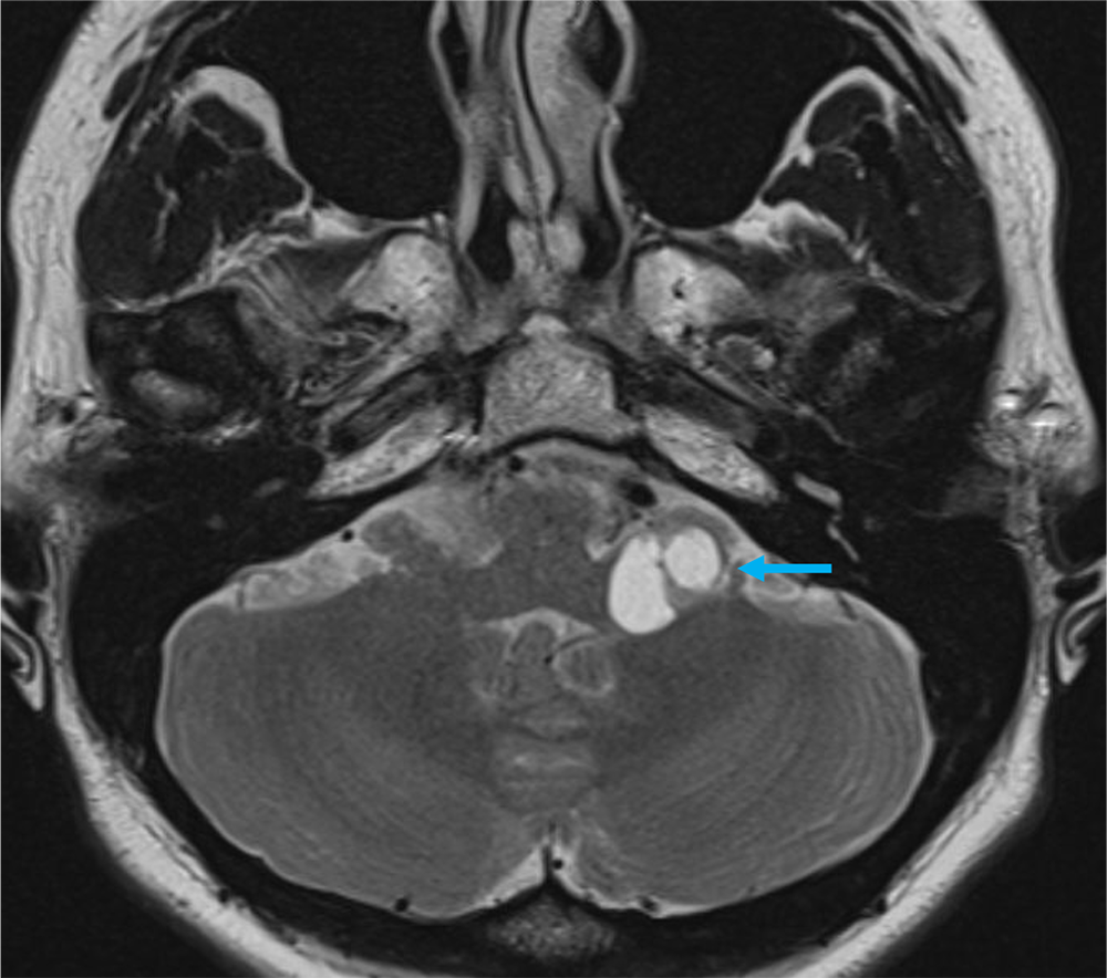 図1．単純MRI T2強調画像