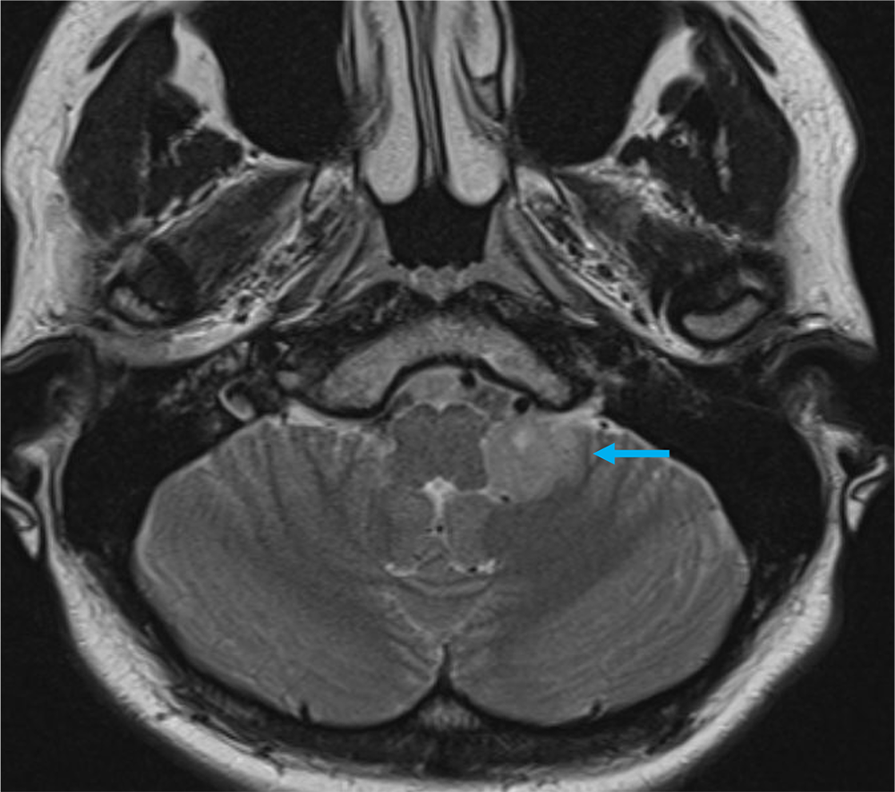 図2．単純MRI T2強調画像