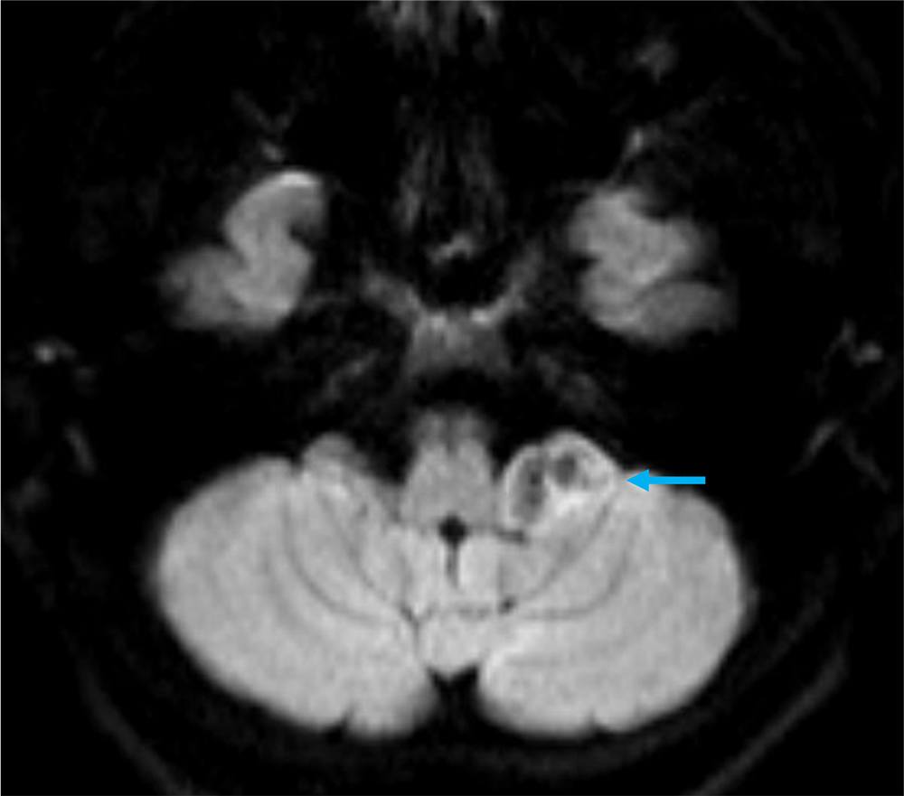 図3．拡散強調画像
