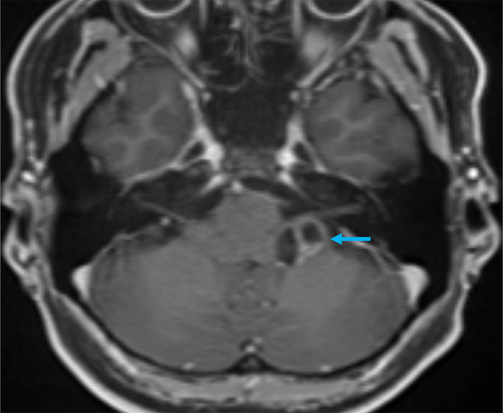 図4. 造影MRI 脂肪抑制T1強調画像 軸位断