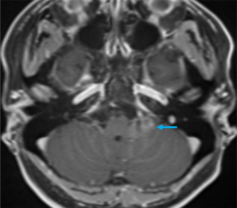 図5．造影MRI 脂肪抑制T1強調画像 軸位断