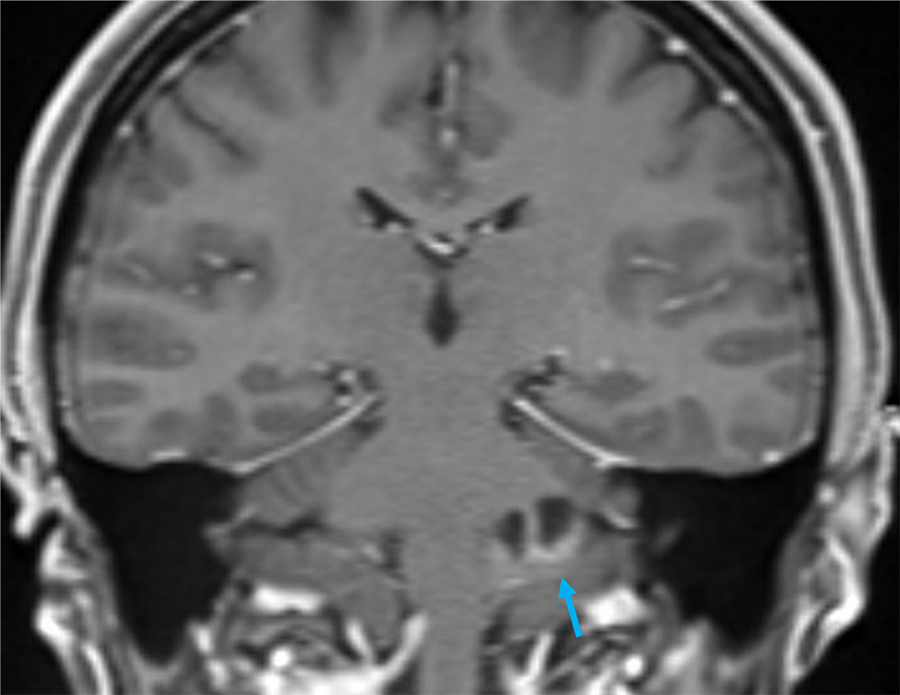図6．造影MRI 脂肪抑制T1強調画像 冠状断