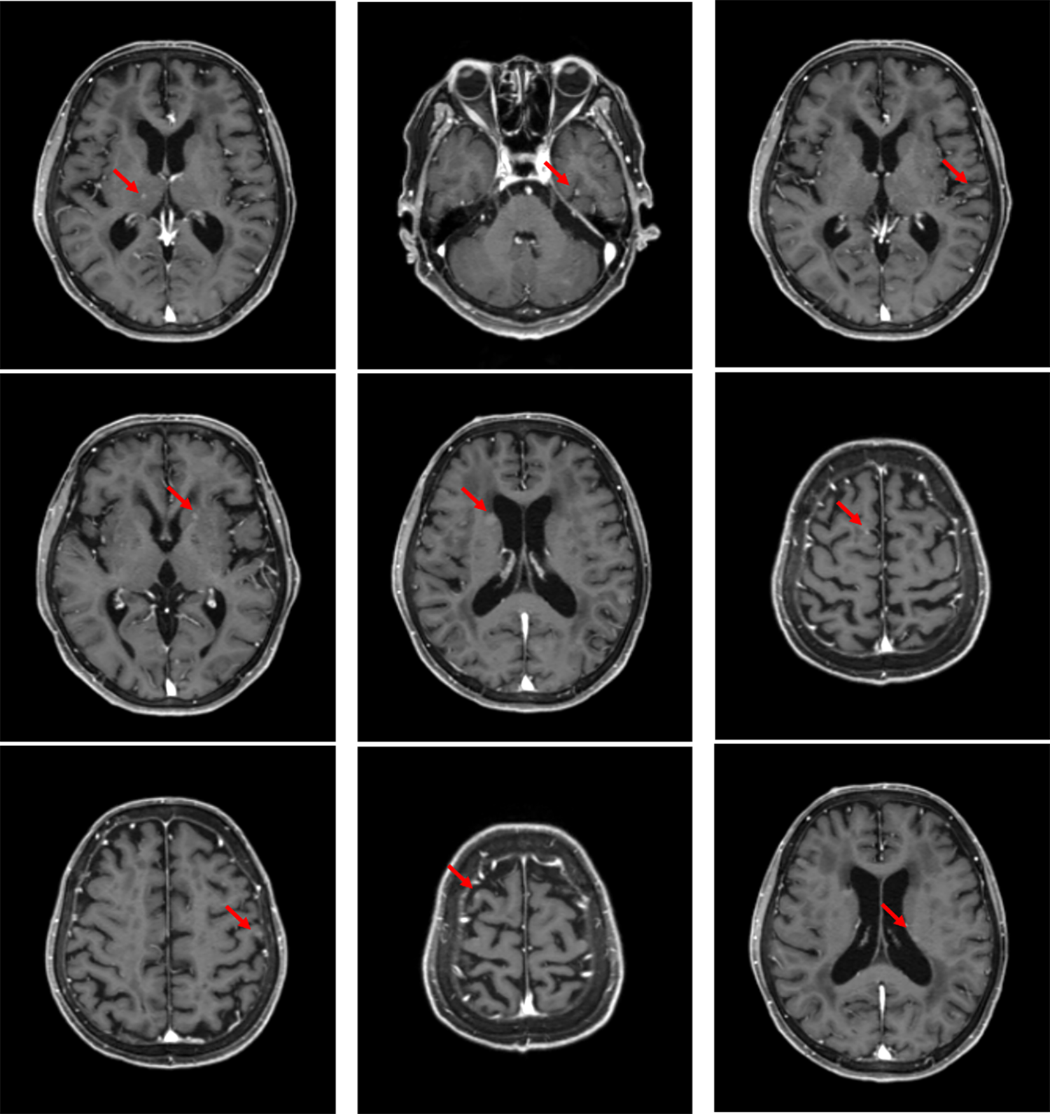 図1．造影T1強調像