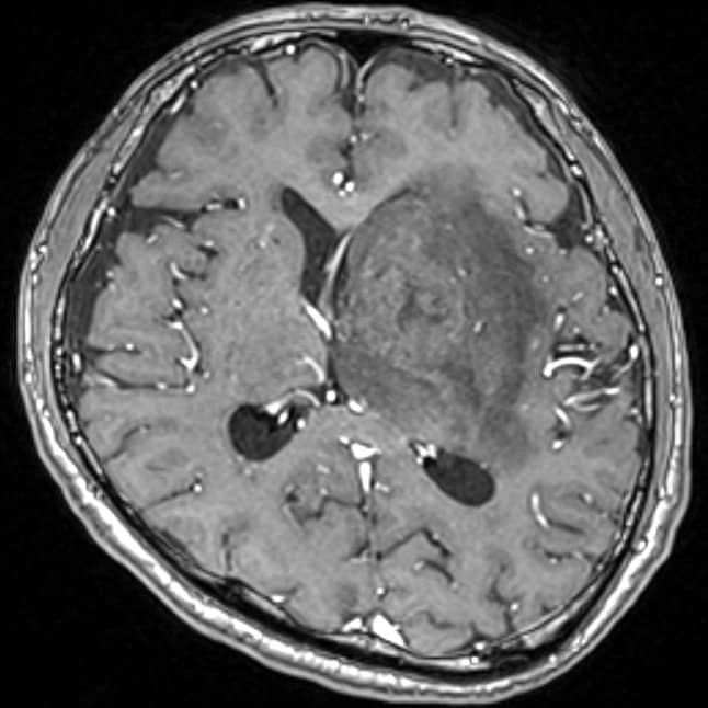 図1．造影T1強調画像（生検手術前）