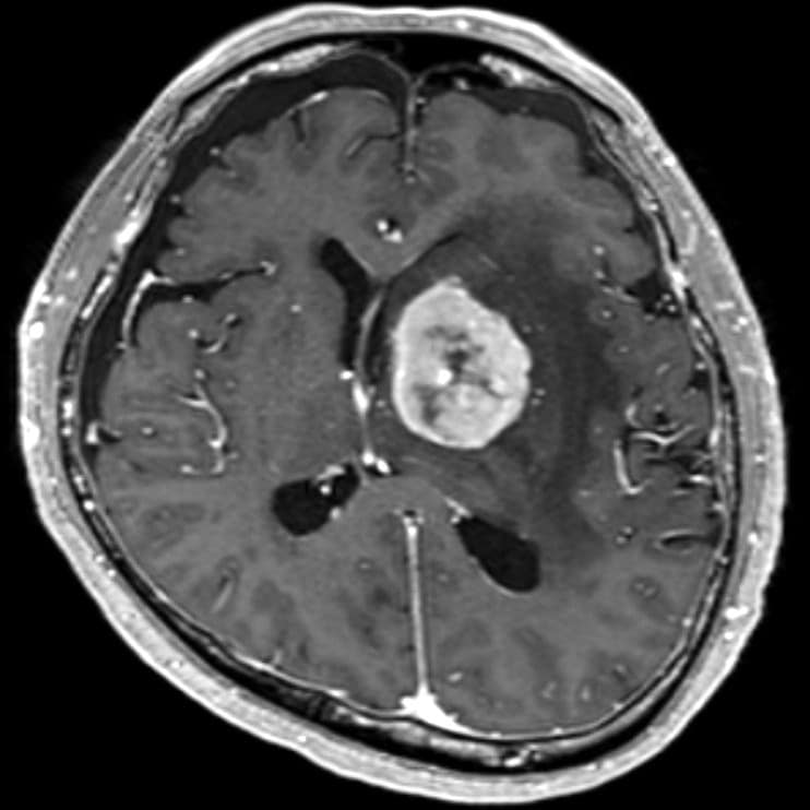 図2．造影T1強調画像（生検手術1週間後）