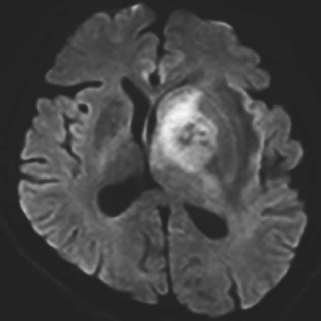 図3．拡散強調画像（生検手術前）