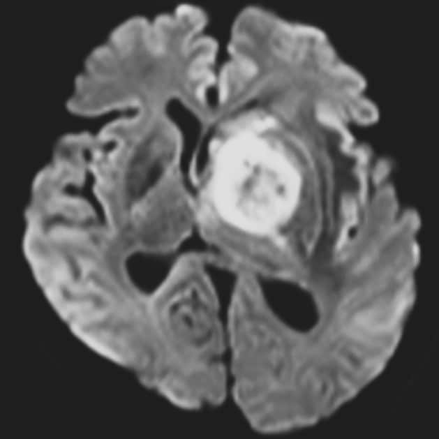 図4．拡散強調画像（生検手術1週間後）