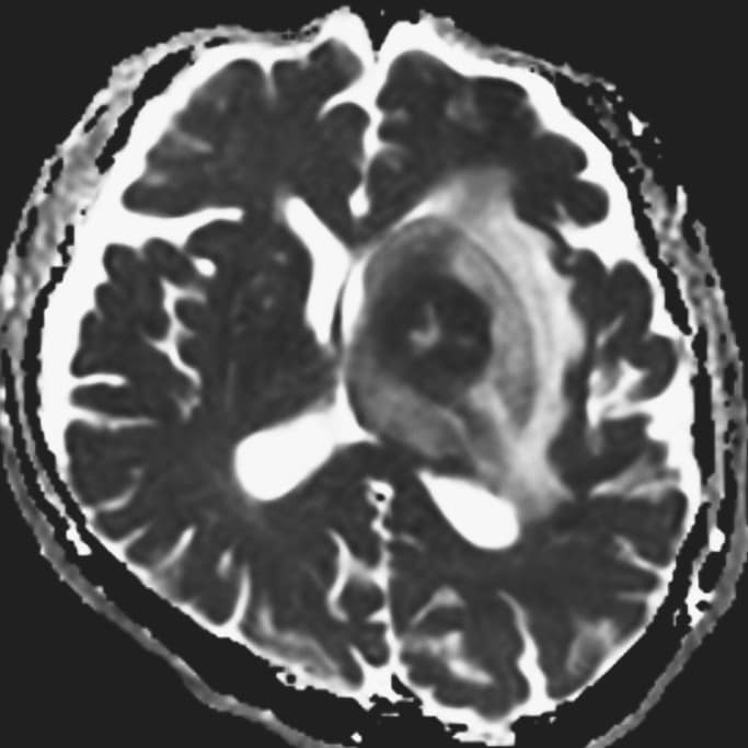 図5．ADC画像（生検手術前）