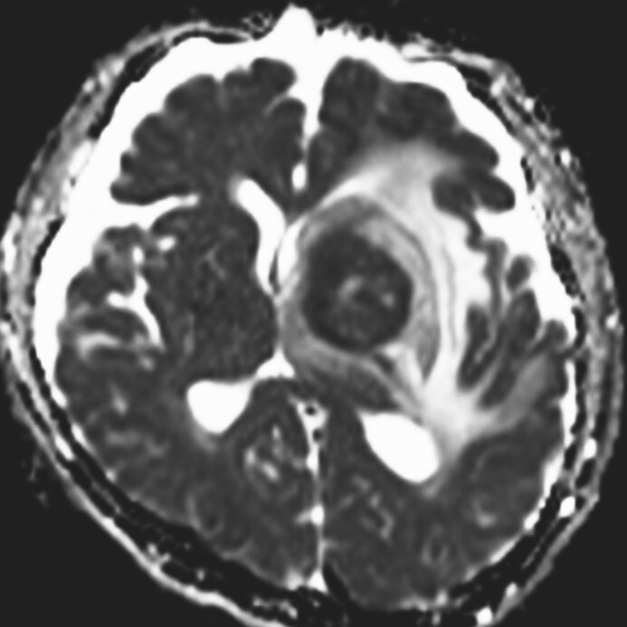 図6．ADC画像（生検手術1週間後）
