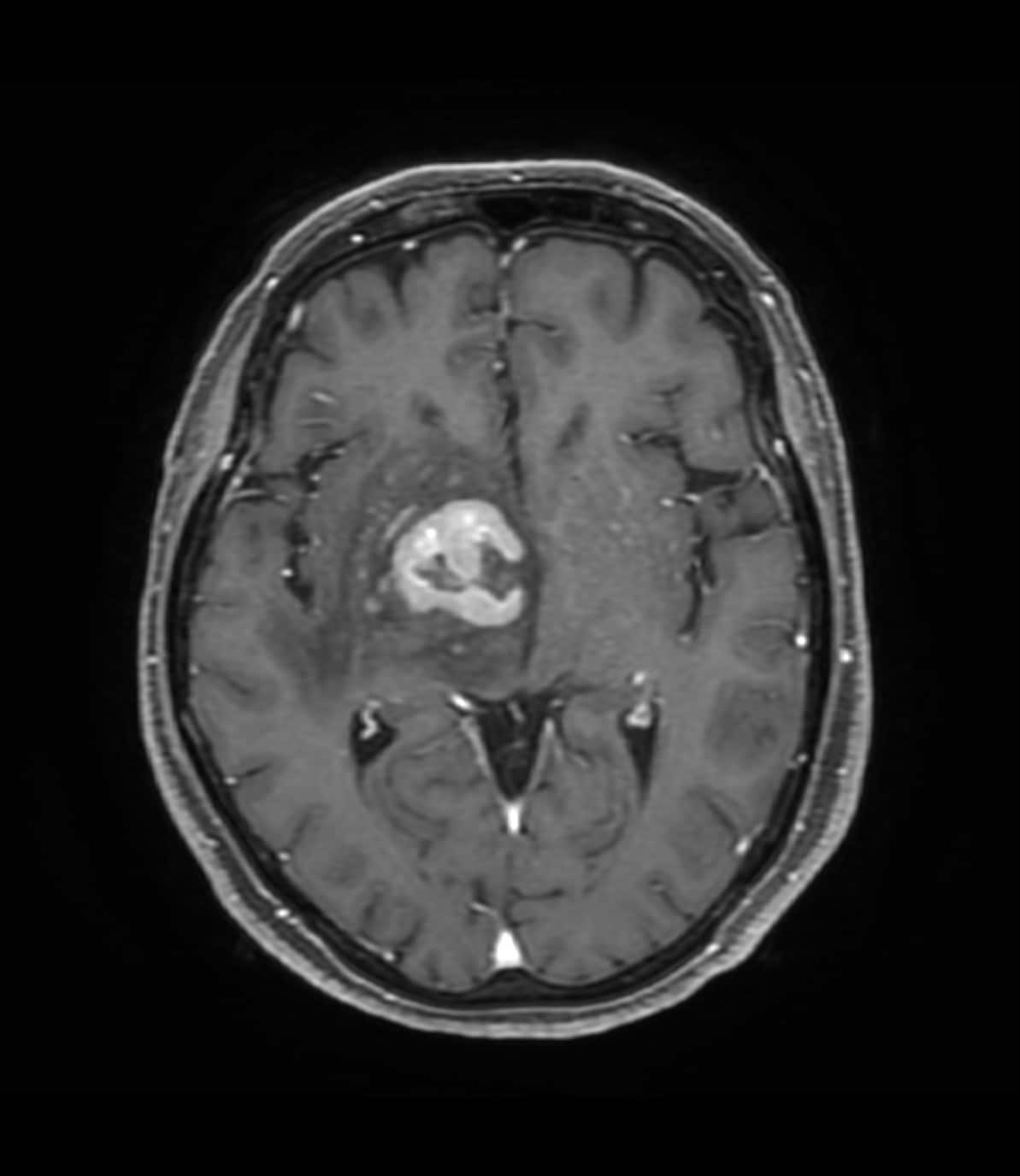 図1．造影T1強調画像、水平断