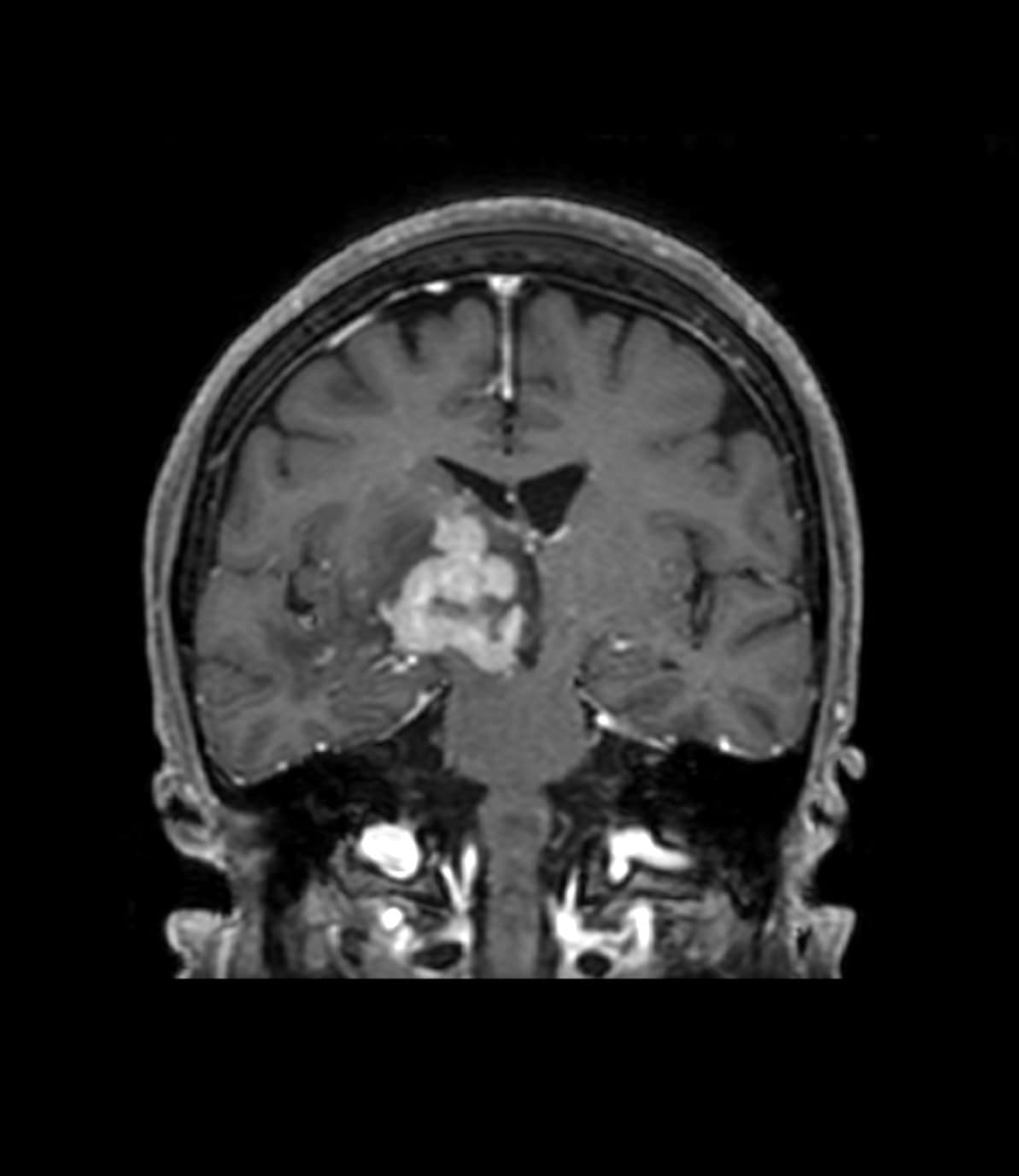 図2．造影T1強調画像、冠状断