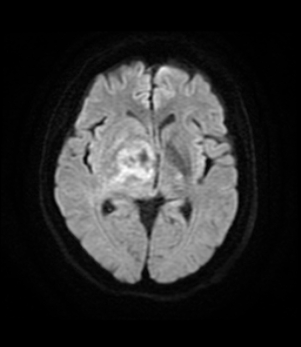 図4．拡散強調画像