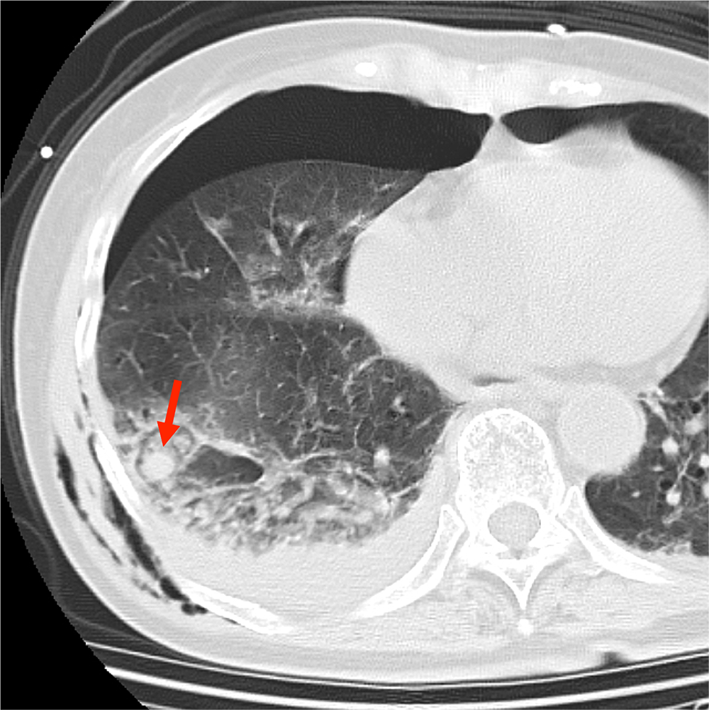 図１．単純CT肺野条件