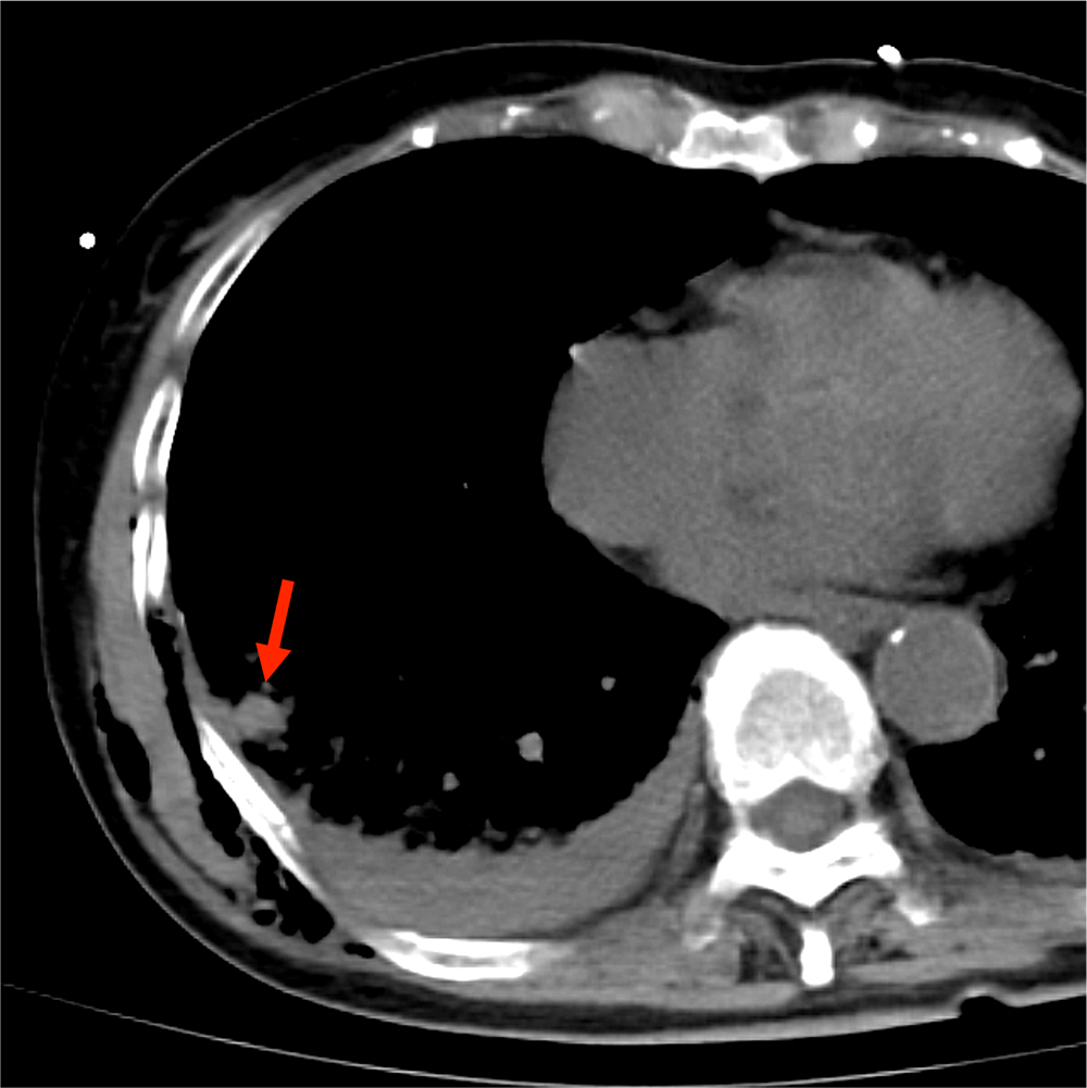 図2．単純CT縦隔条件