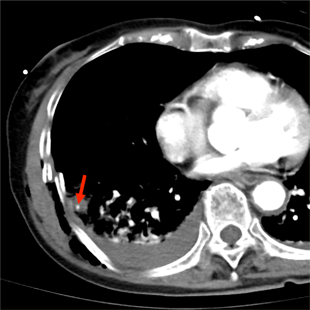 図3．造影CT動脈相
