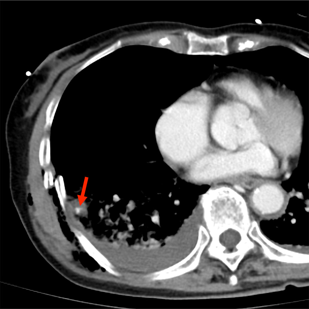 図4．造影CT平衡相