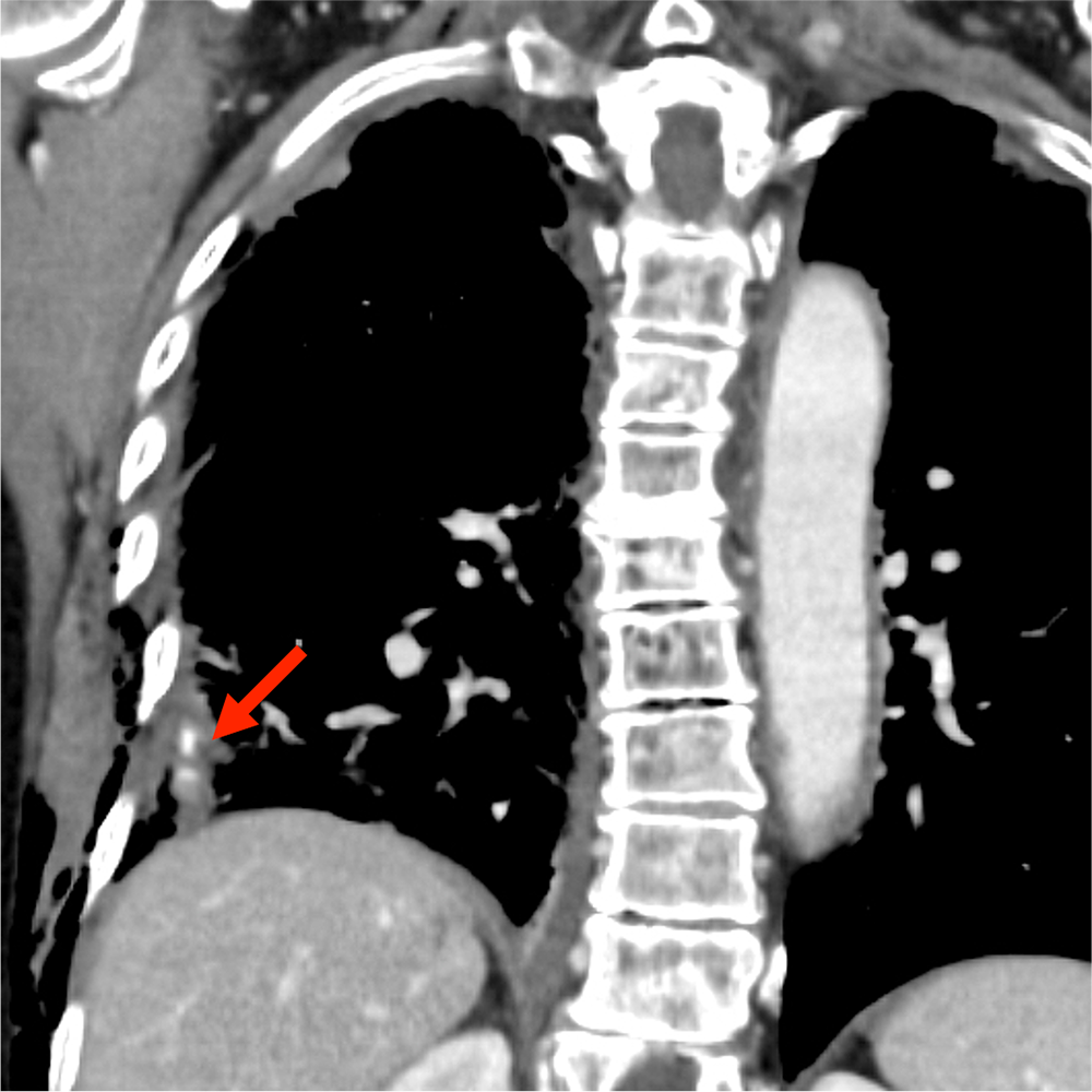 図5．造影CT平衡相（胸部冠状断像）
