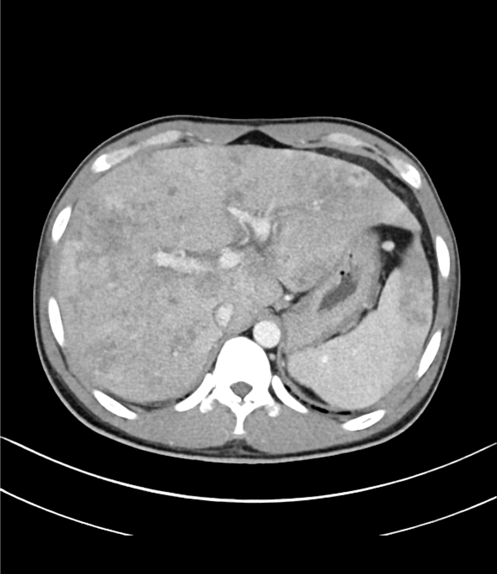 図2．後期動脈相