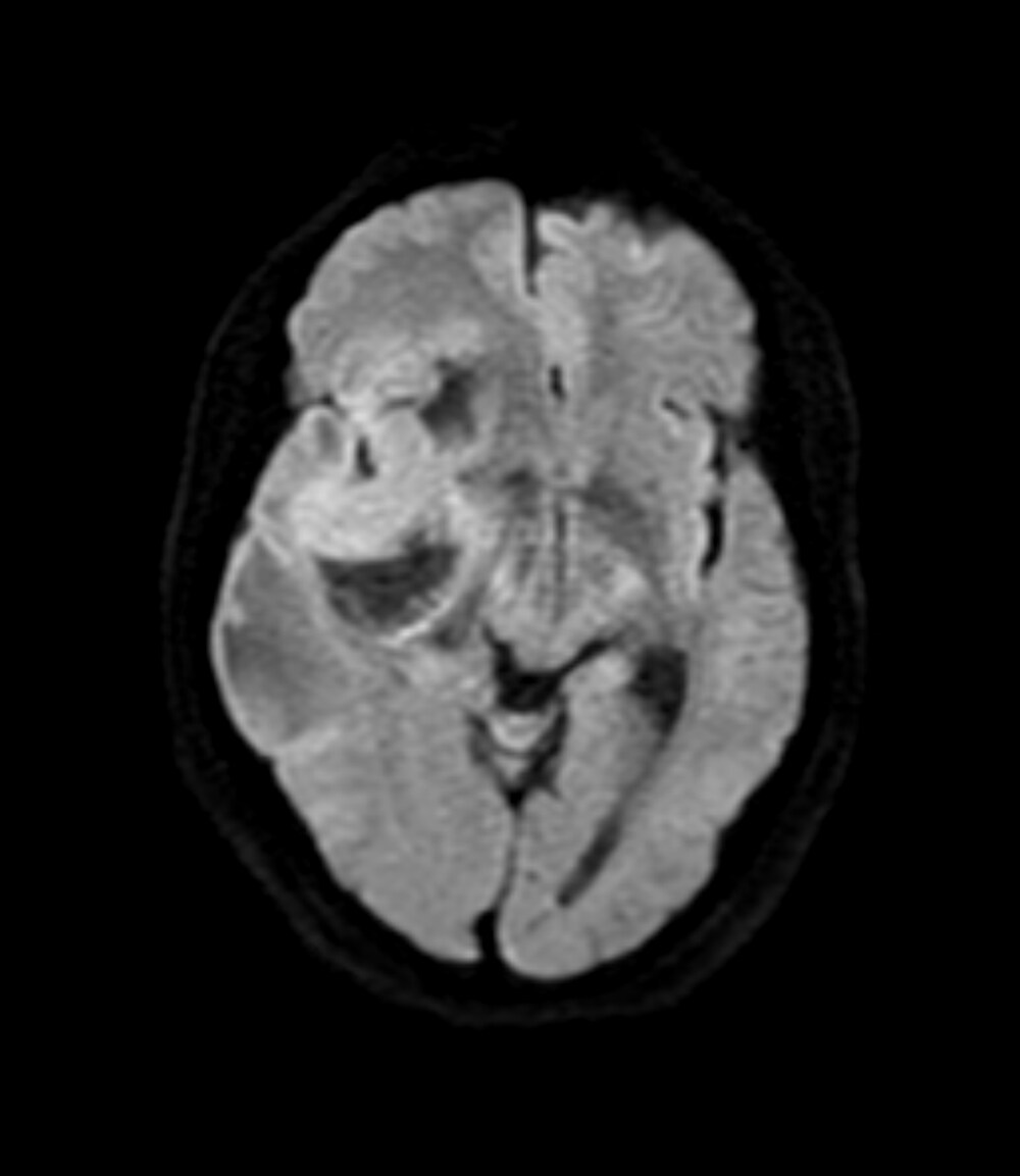 図2．拡散強調画像