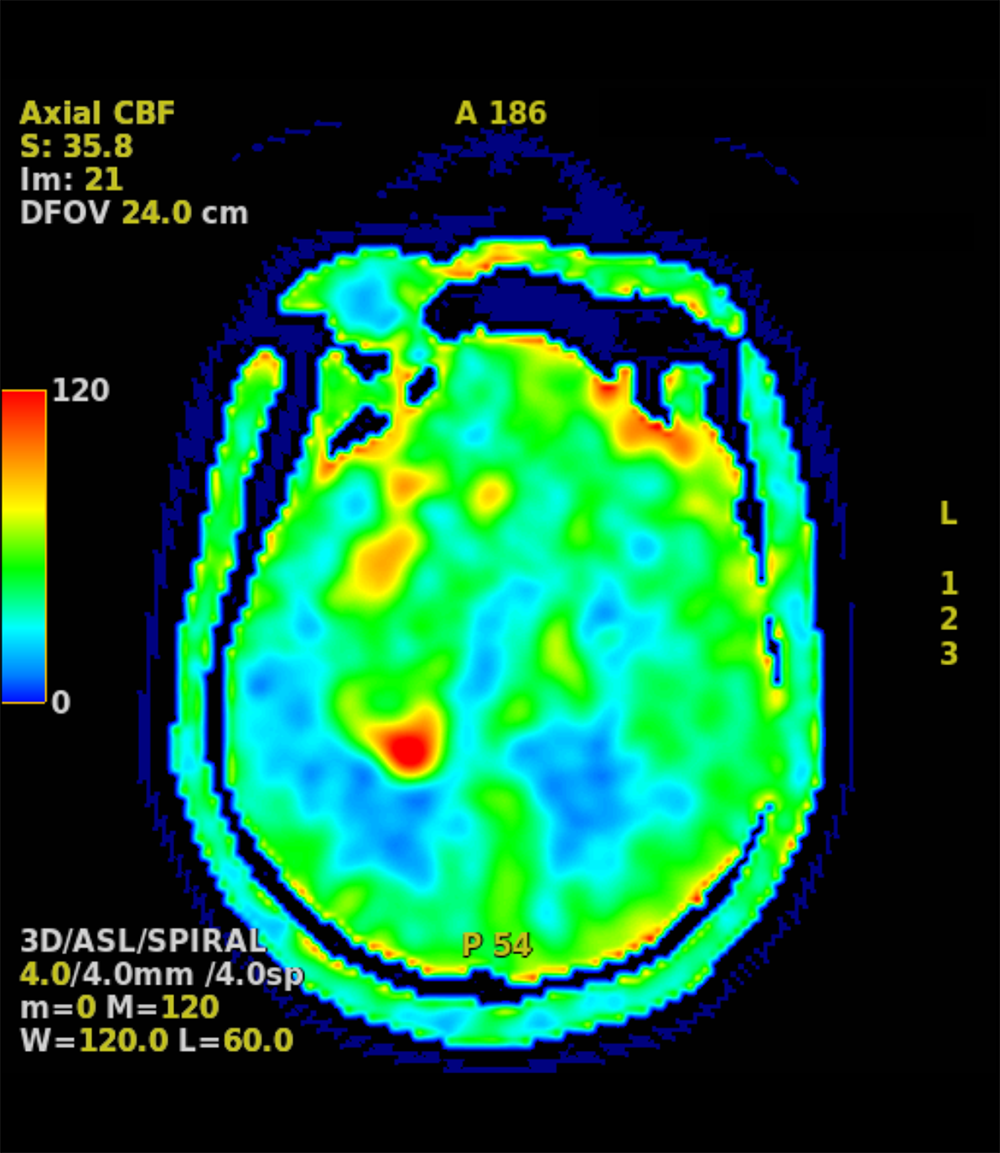 図3．MR perfusion