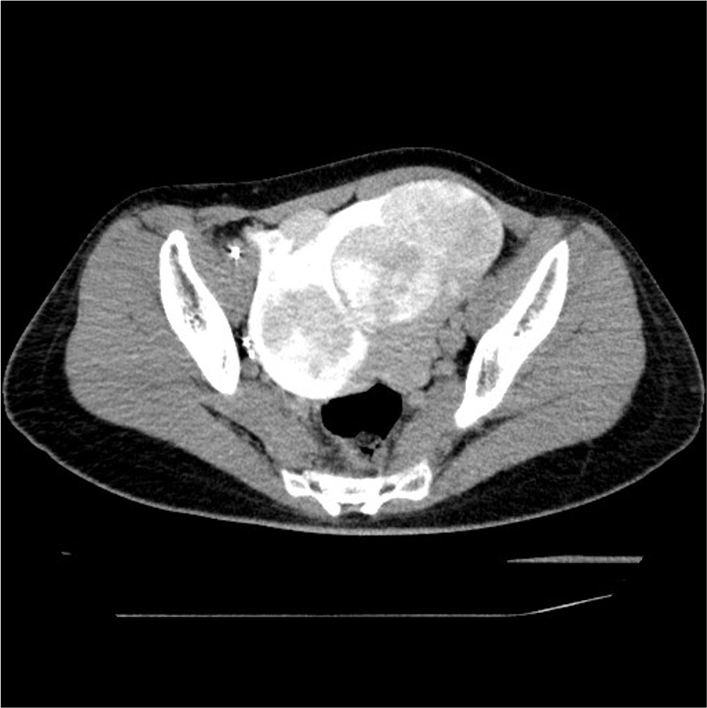 図3．両側子宮動脈塞栓術後の単純CT