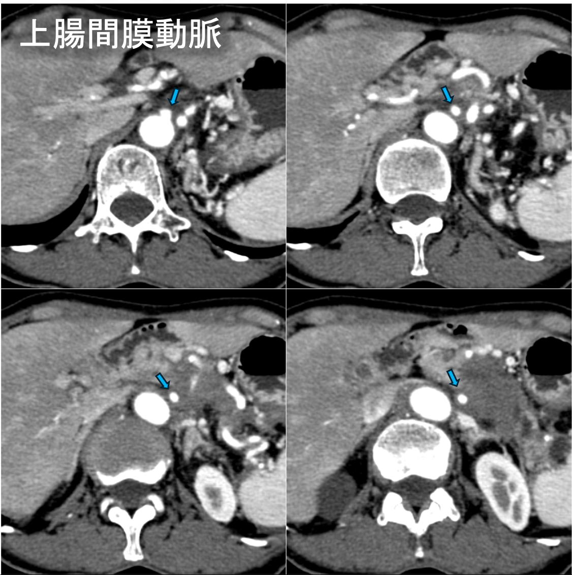 図2．横断断像（動脈相）