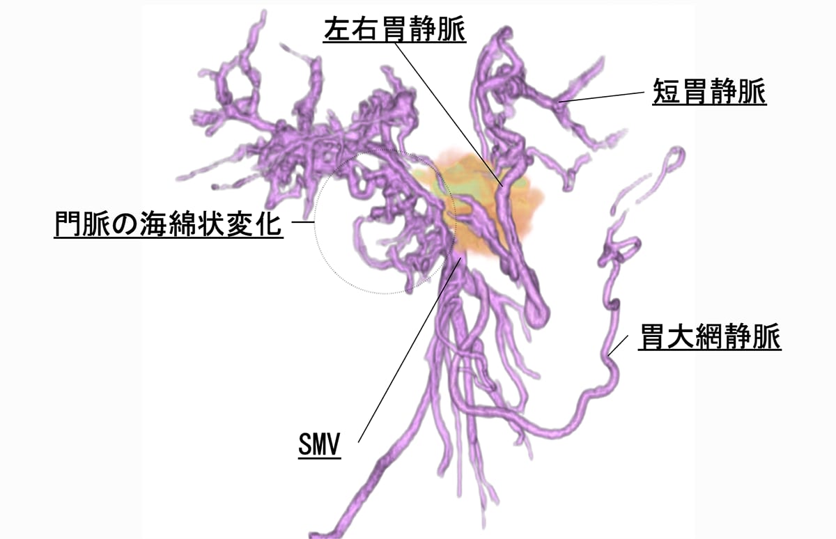 図3．門脈系の3D画像（門脈相）