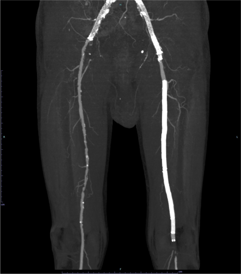 図１．下肢造影CT MIP(maximum intensity projection)像 (腸骨・大腿・膝窩領域)