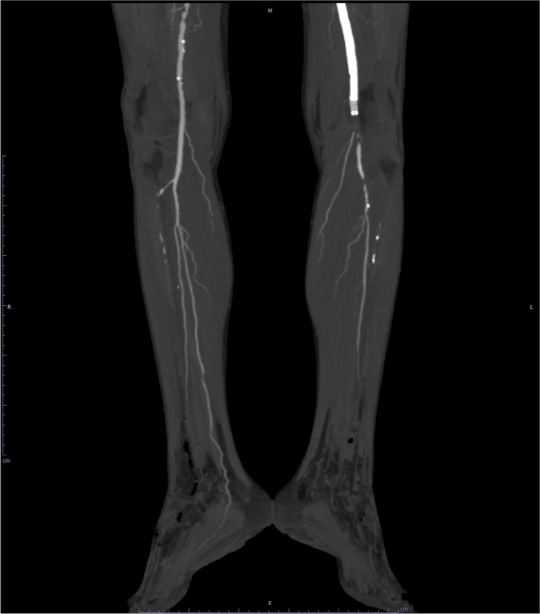 図2．下肢造影CT MIP像 (膝窩・膝下領域)