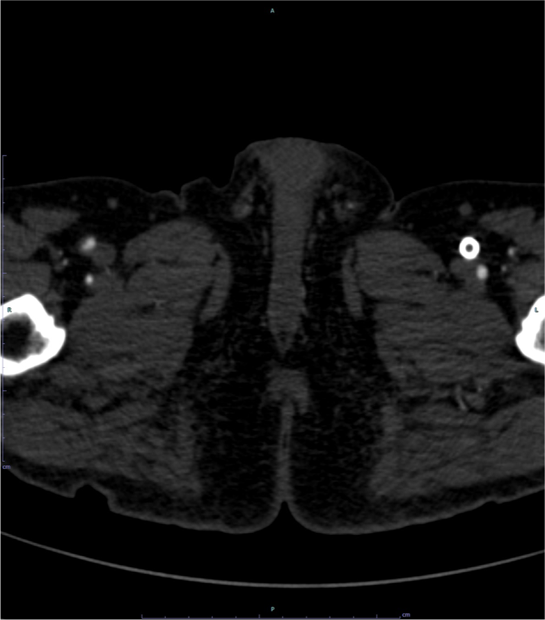 図3．下肢造影CT(左SFAステント近位部レベル)