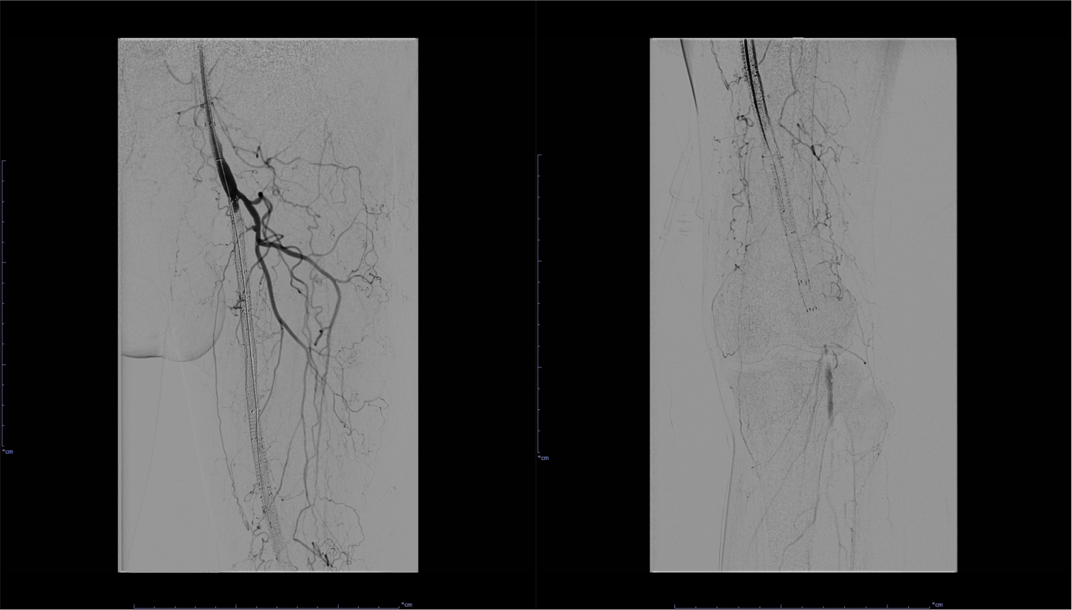 図4．左SFA～Pop. A血管造影(治療前)