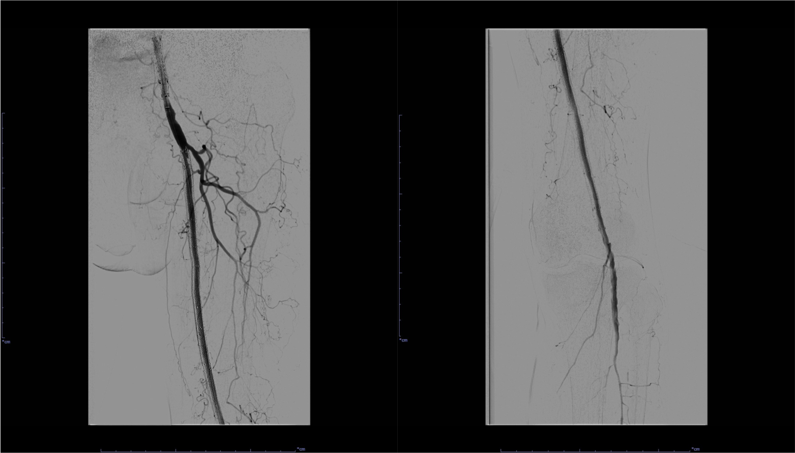 図5．左SFA～Pop. A血管造影(PTA治療後)