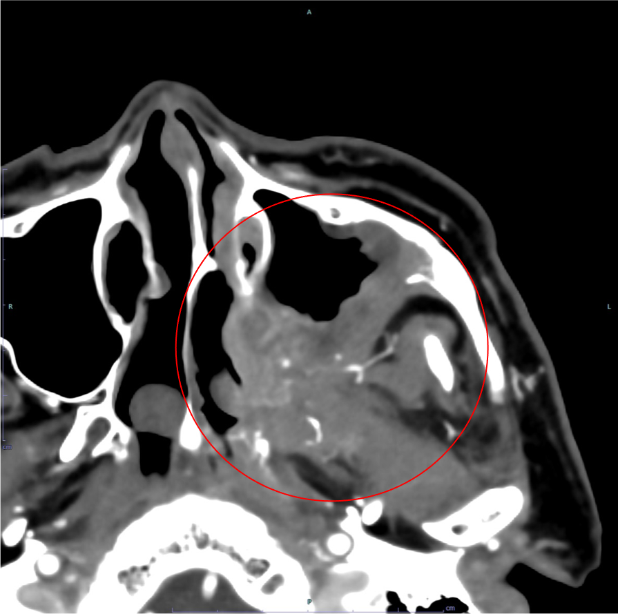 図１．造影CT 動脈相