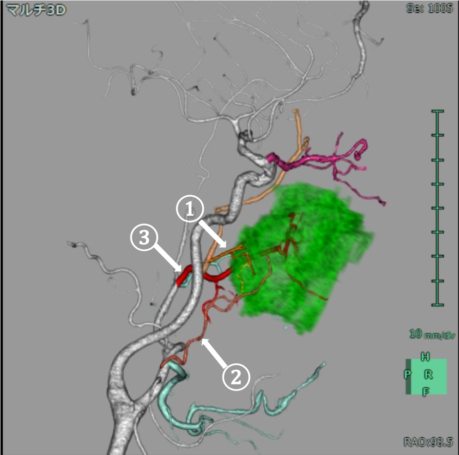 図2．造影CTより作成した支援画像(側面像)