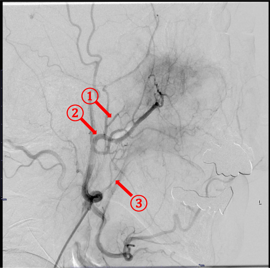 図3．DSA側面像(左外頸動脈起始部より造影)