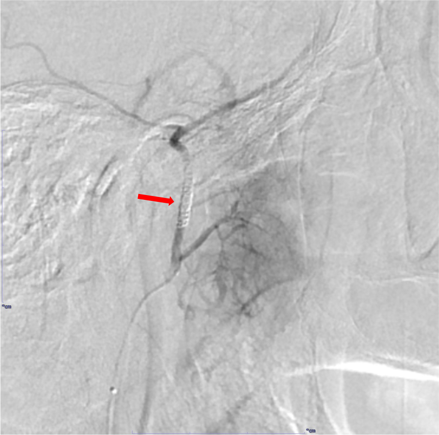 図4．DSA(副硬膜動脈より選択的造影)