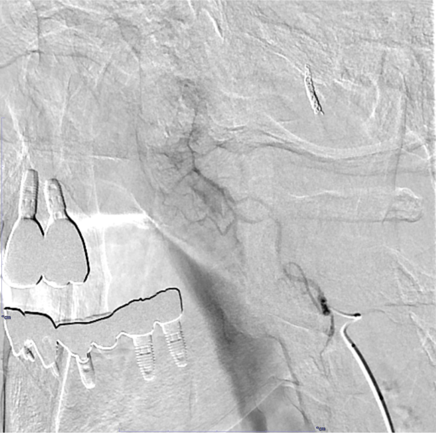 図5．DSA(上行口蓋動脈より選択的造影)
