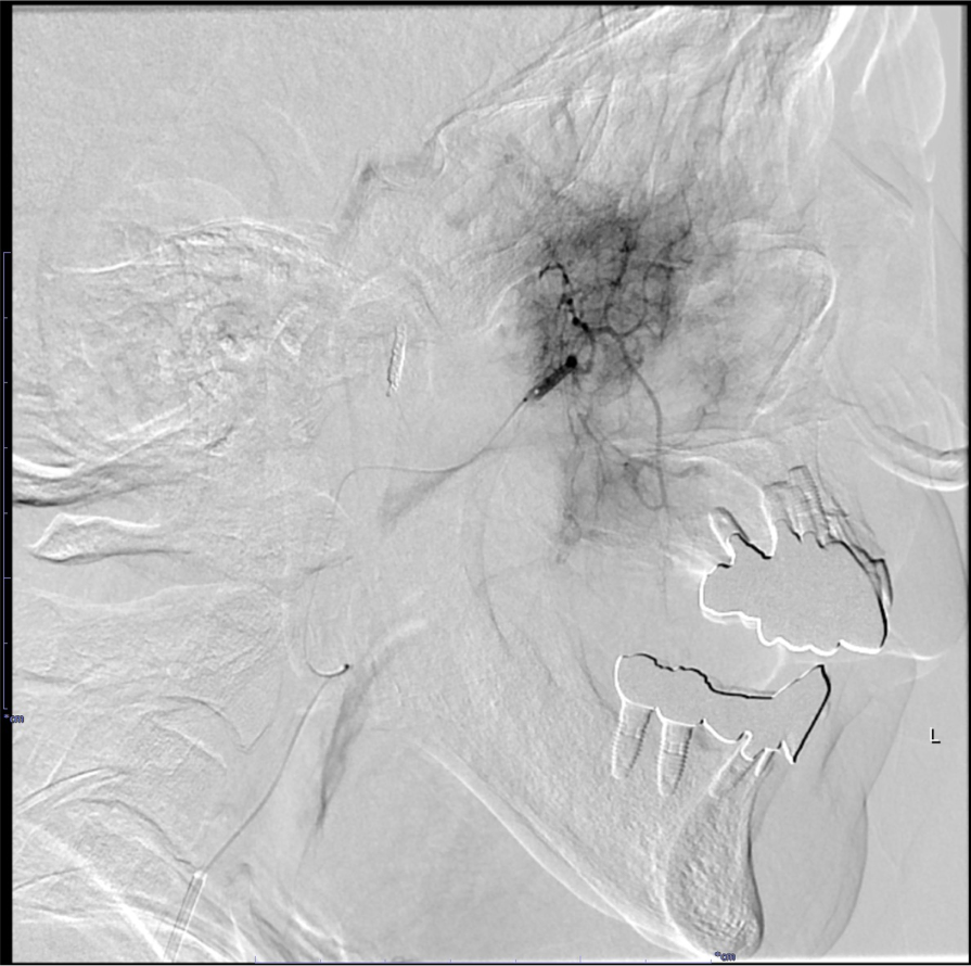 図6．DSA(顎動脈より選択的造影)