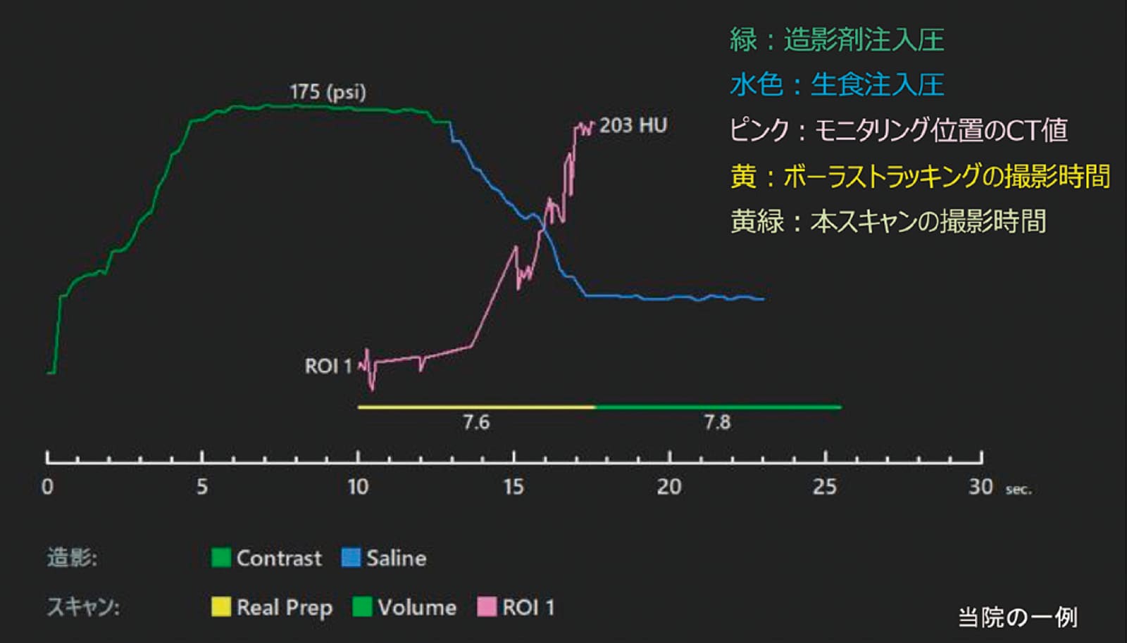 冠動脈CT検査における造影剤注入結果